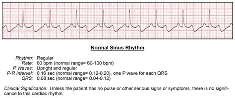 Normal Sinus Rhythm. How to recognize it on an .